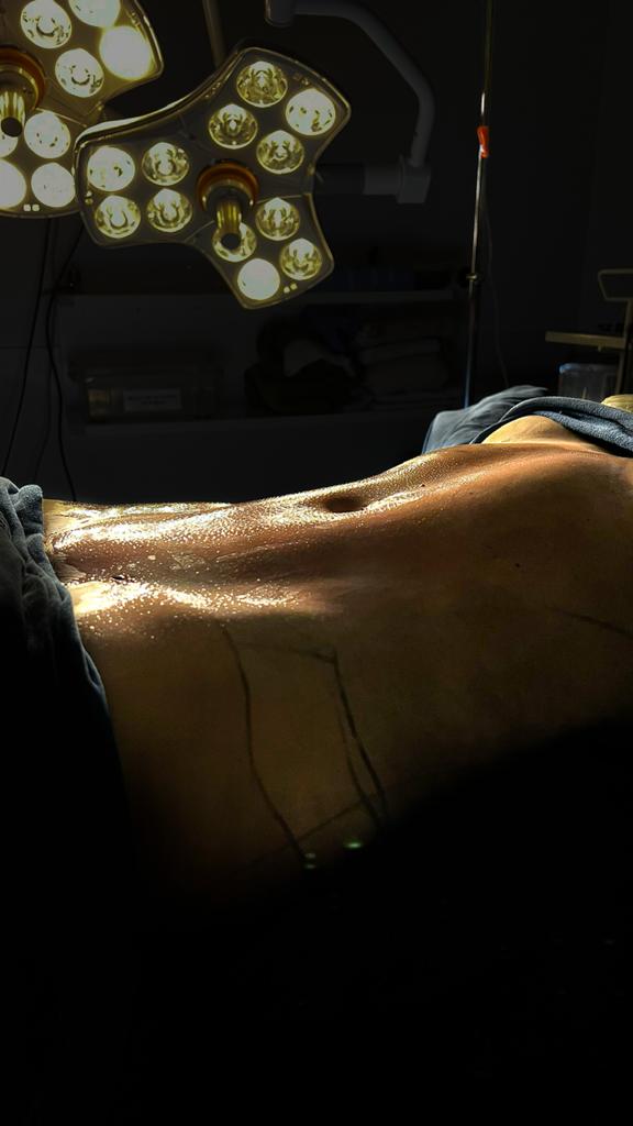 cirurgia-plastica-lipo-ha-lipoaspiracao-de-alta-definicao-mesa-de-cirurgia-com-paciente2-2