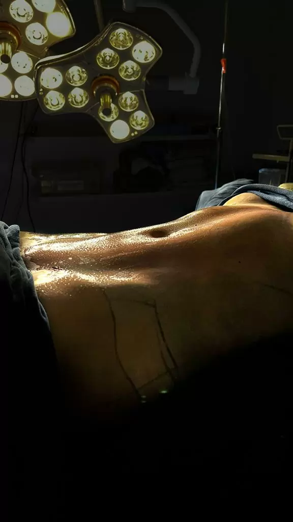 cirurgia-plastica-lipo-ha-lipoaspiracao-de-alta-definicao-mesa-de-cirurgia-com-paciente2-2
